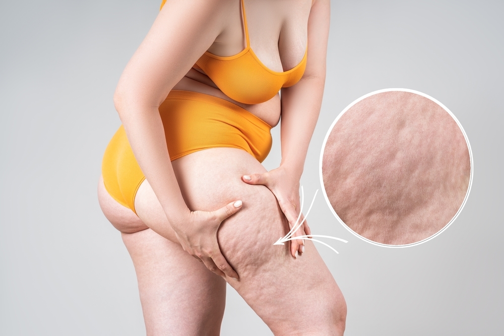 Tratamento do Lipedema, Dra. Gabriela Laboissiere